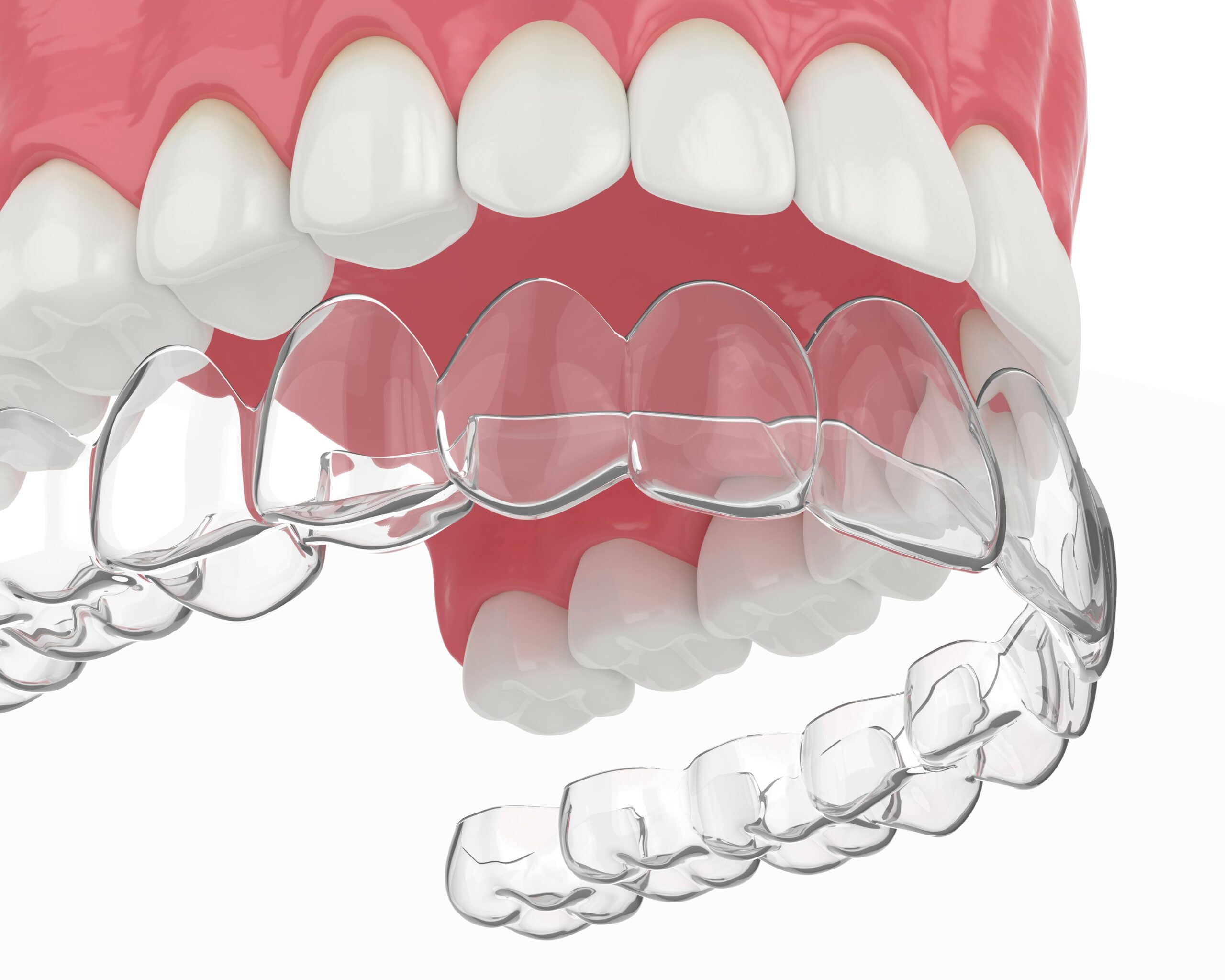 Invisalign: Straighten Your Smile Without the Hassle